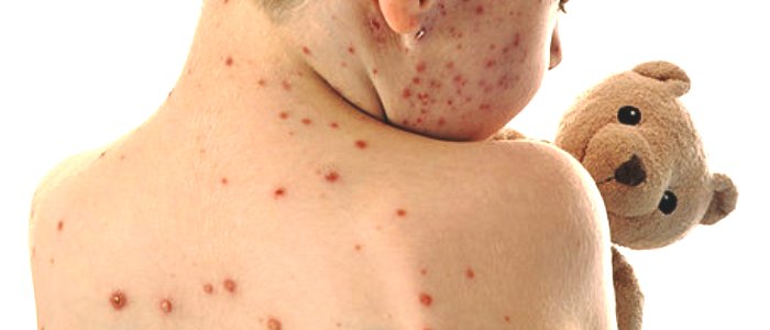 La libertà ai tempi del morbillo