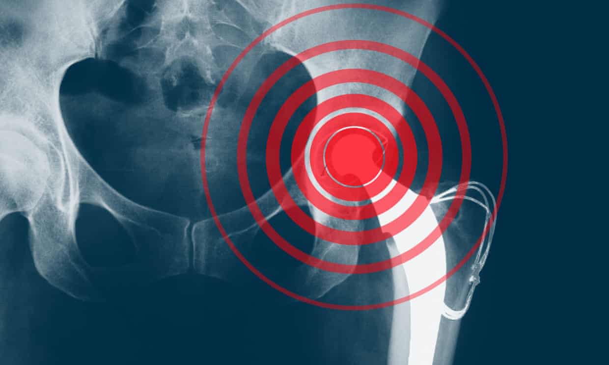 Accertato: Protesi difettose provocano lesioni in pazienti di tutto il mondo