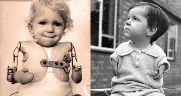Effetti talidomide