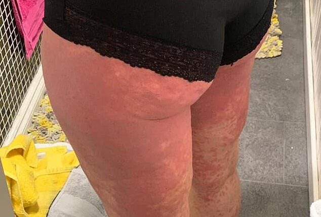 Vaccino rash cutaneo