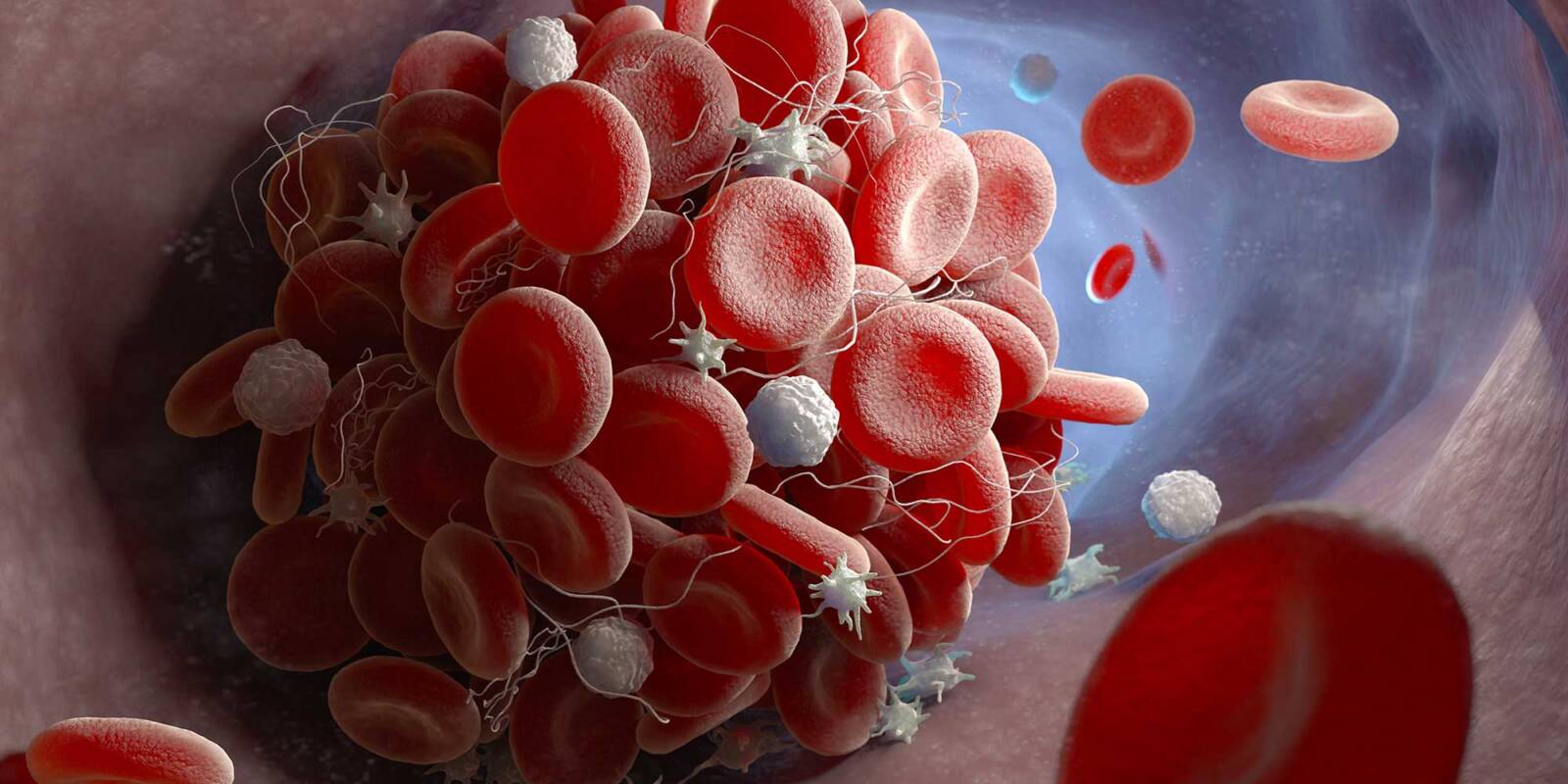 Vaccini Covid e trombosi – Il punto della situazione