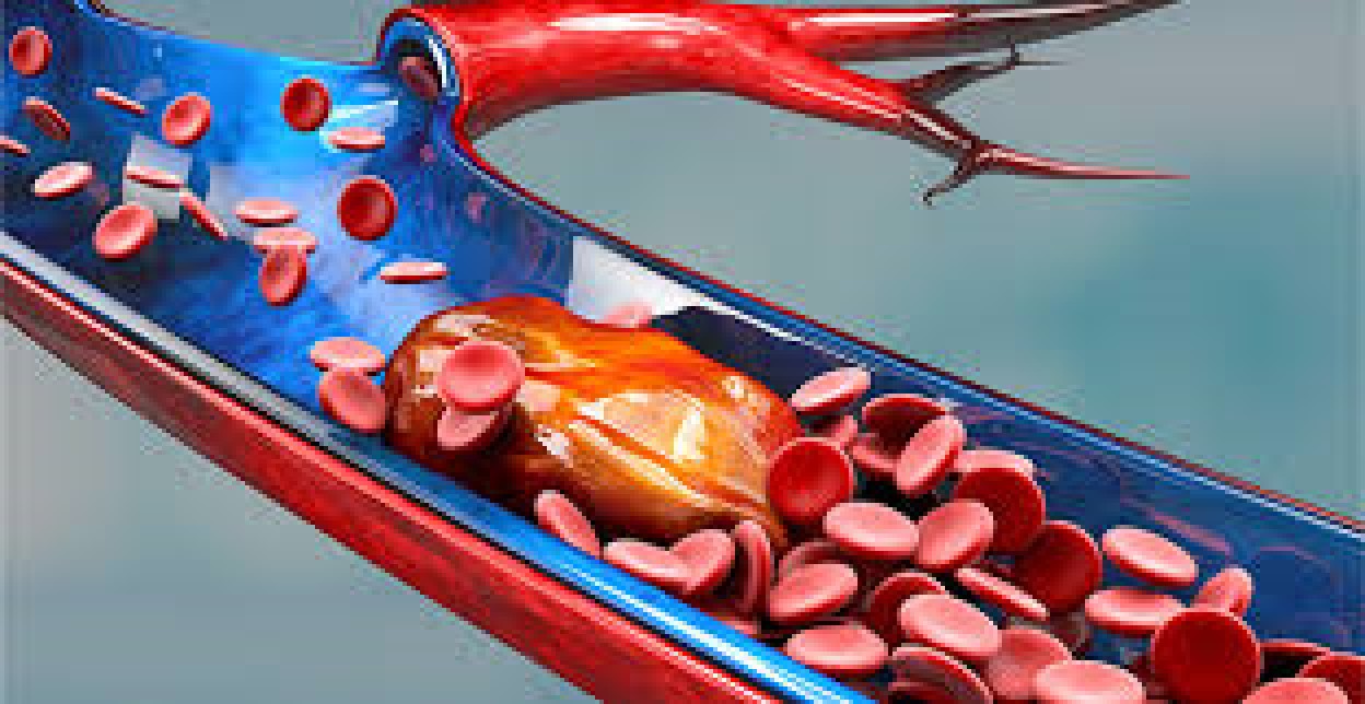 Imbalsamatore scopre trombi ematici rivelatori