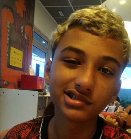 13enne con paresi facciale dopo la seconda dose