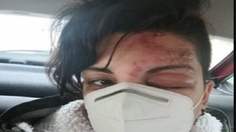 Grave reazione allergica dopo la terza dose per una 30enne catanzarese
