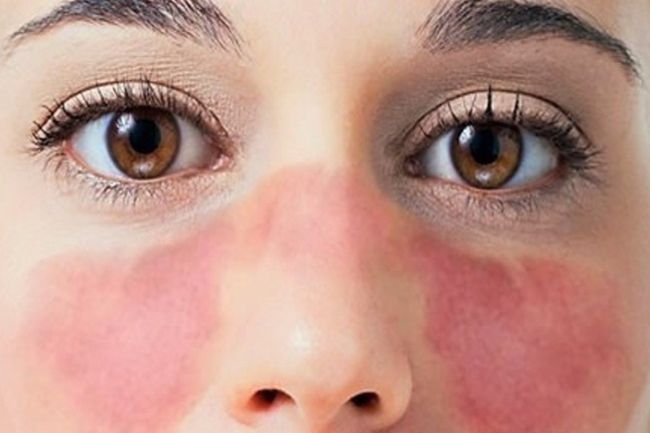 Lupus eritematoso sistemico e sindrome da anticorpi antifosfolipidi dopo il vaccino Pfizer