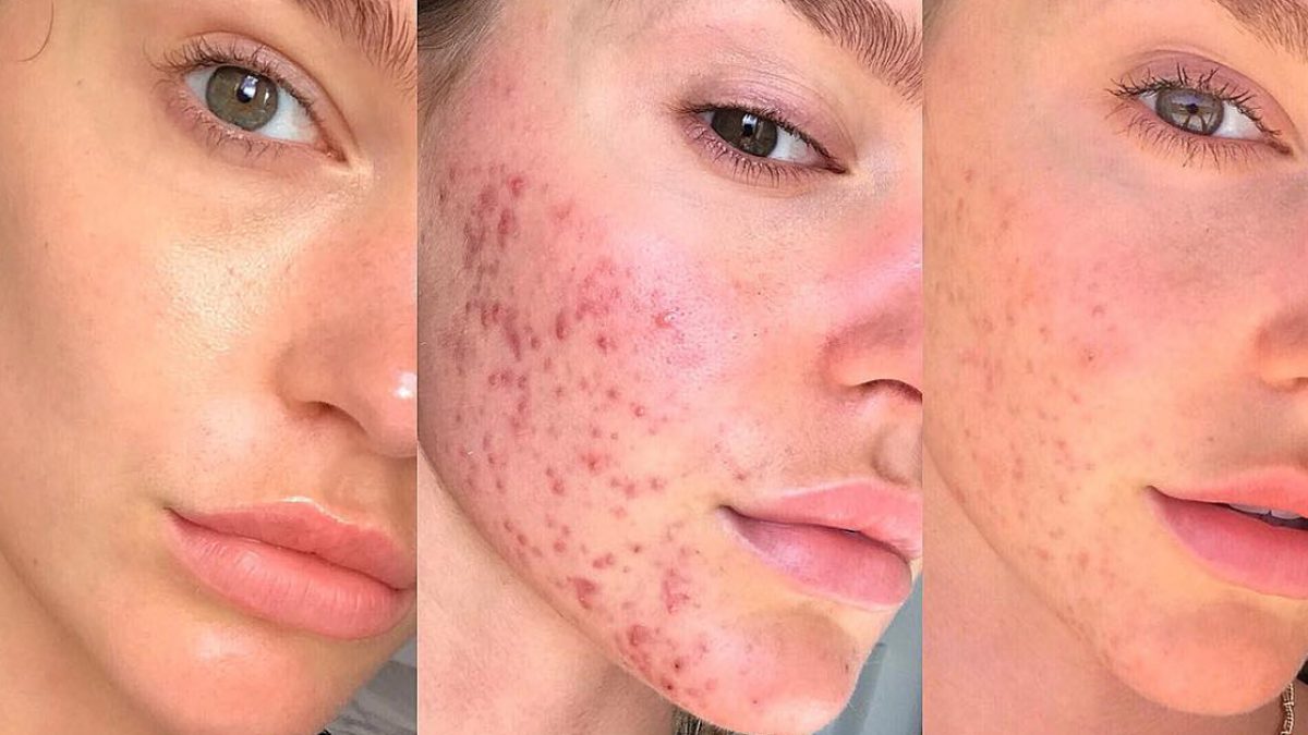 Acne, batteri al posto degli antibiotici