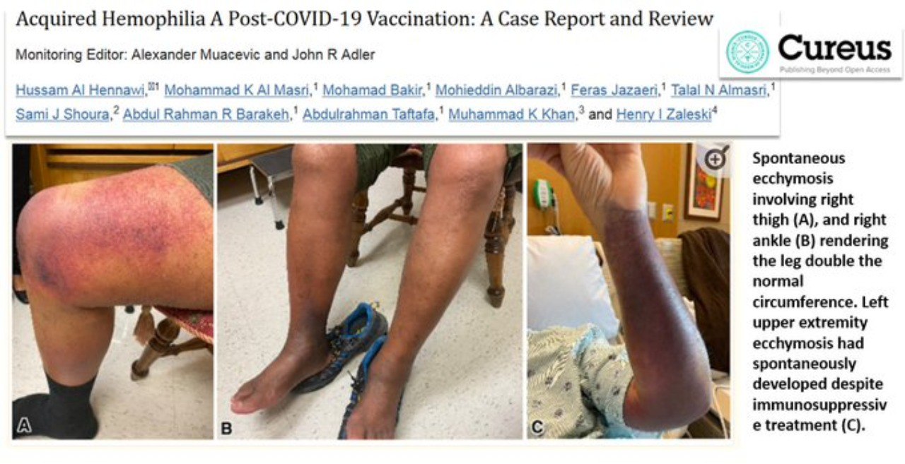 Emofilia acquisita da vaccinazione post-COVID-19 un caso clinico