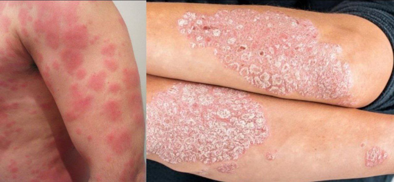 Orticaria cronica, psoriasi ed eczema dopo la vaccinazione con mRNA casi clinici