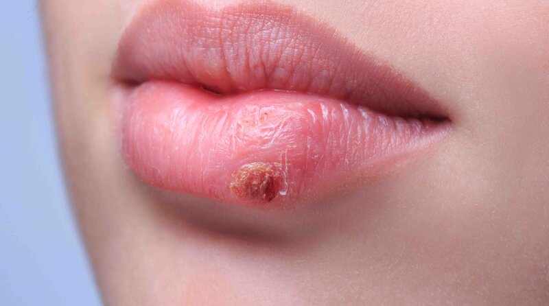 Herpes labiale, due efficaci trattamenti locali