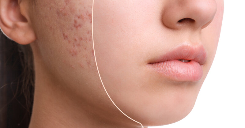 Acne, studio evidenzia collegamento con importante nutriente chiave