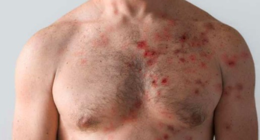 36enne vaccinato con Pfizer si ammala di vaiolo delle scimmie, HIV e covid