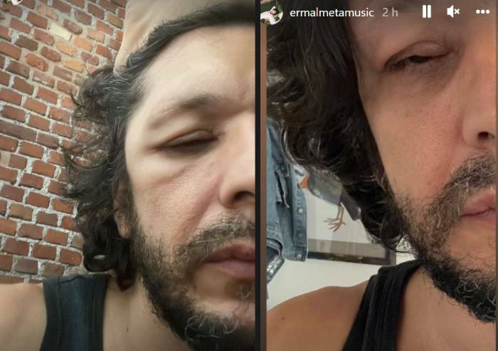 Ermal Meta choc Mi si gonfia il viso e la testa