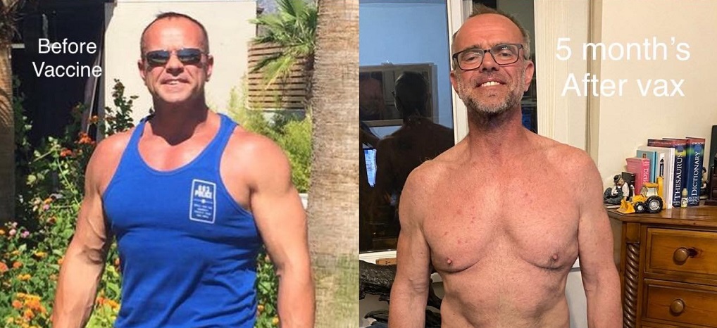 Uomo in ottime condizioni di salute sviluppa grave reazione avversa al vaccino AstraZeneca